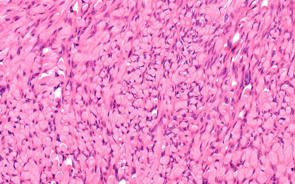 3B4 Meningioma, Hyalinized, psammomatous (Case 3) H&E 4