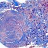 3C1 Meningioma, Hyalinized, psammomatous (Case 3) Tri 2X