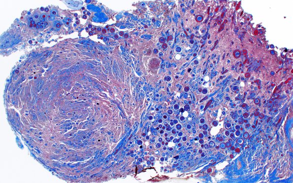 3C1 Meningioma, Hyalinized, psammomatous (Case 3) Tri 2X