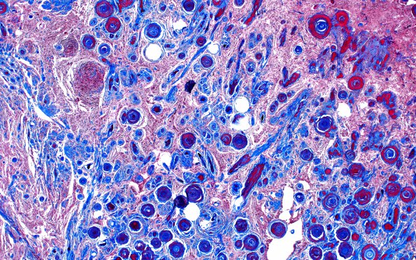 3C2 Meningioma, Hyalinized, psammomatous (Case 3) Tri 4X