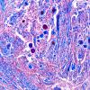 3C3 Meningioma, Hyalinized, psammomatous (Case 3) Trichrome