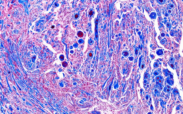 3C3 Meningioma, Hyalinized, psammomatous (Case 3) Trichrome