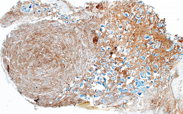 3D Meningioma, Hyalinized, psammomatous (Case 3) EMA 2X