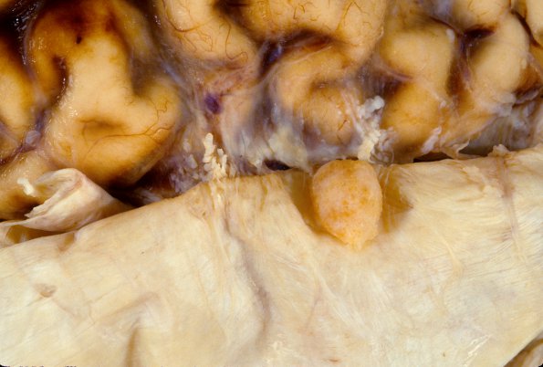 4A1 Meningioma (Case 4)