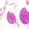 4B1 Meningioma, numerous psammoma bodies (Case 4) H&E WM