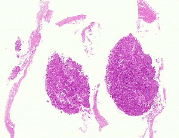 4B1 Meningioma, numerous psammoma bodies (Case 4) H&E WM