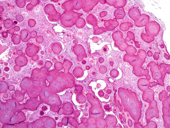 4B2 Meningioma, numerous psammoma bodies (Case 4) H&E 3