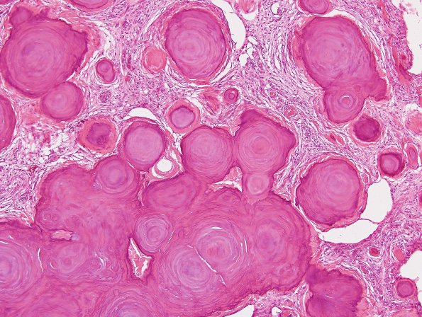 4B3 Meningioma, numerous psammoma bodies (Case 4) H&E 2