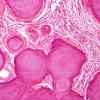 4B4 Meningioma, numerous psammoma bodies (Case 4) H&E 1