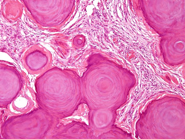 4B4 Meningioma, numerous psammoma bodies (Case 4) H&E 1