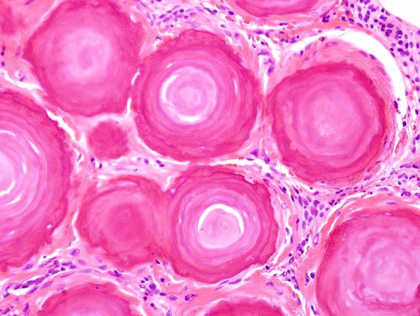 4B5 Meningioma, psamommatous (Case 4) H&E 1