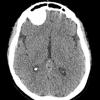 5A1 Meningioma, psammomatous (Case 5) CT - Copy