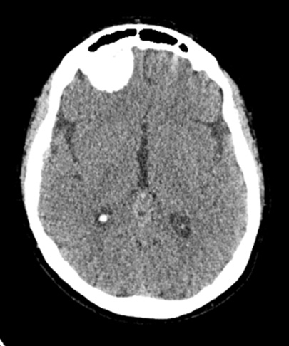 5A1 Meningioma, psammomatous (Case 5) CT - Copy