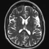 5A2 Meningioma, psammomatous (Case 5) T2 no C - Copy