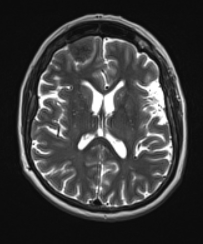 5A2 Meningioma, psammomatous (Case 5) T2 no C - Copy