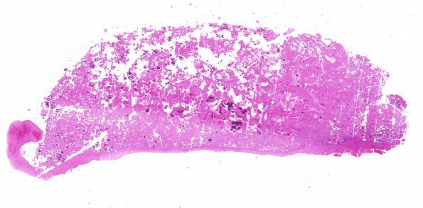 5B1 Meningioma, psammomatous (Case 5) H&E WM