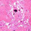 5B3 Meningioma, psammomatous (Case 5) H&E 1.jpg