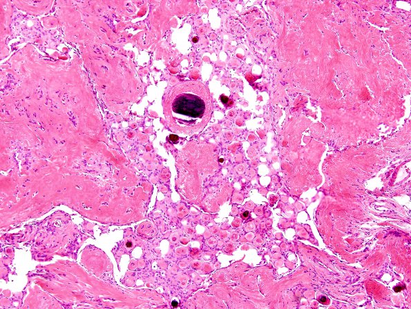 5B3 Meningioma, psammomatous (Case 5) H&E 1.jpg