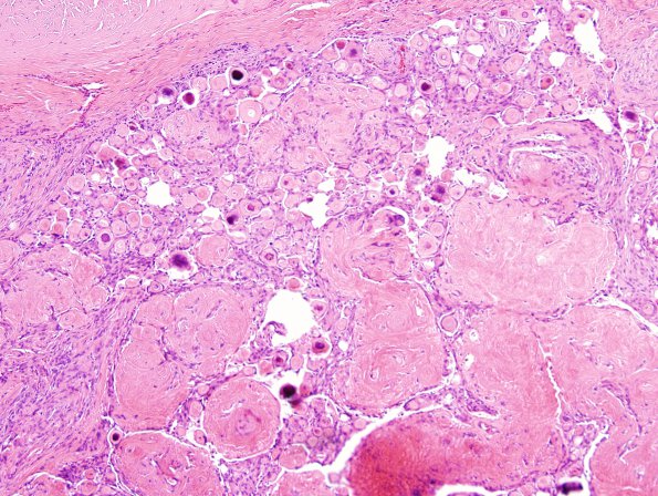 5B4 Meningioma, psammomatous (Case 5) H&E 5.jpg