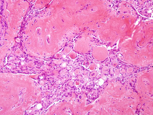 5B5 Meningioma, psammomatous (Case 5) H&E 3.jpg