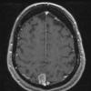 6A Meningioma, unusual psammoma bodies (Case 6) T1W - Copy