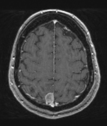 6A Meningioma, unusual psammoma bodies (Case 6) T1W - Copy