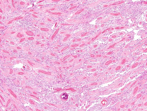 6B1 Meningioma, unusual psammoma bodies (Case 6) H&E 4.jpg