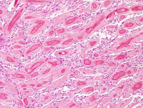 6B2 Meningioma, unusual psammoma bodies (Case 6) H&E 3.jpg