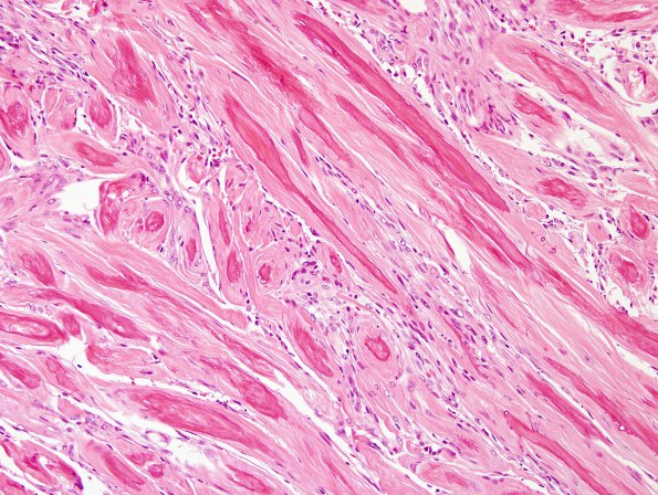 6B3 Meningioma, unusual psammoma bodies (Case 6) H&E 1.jpg