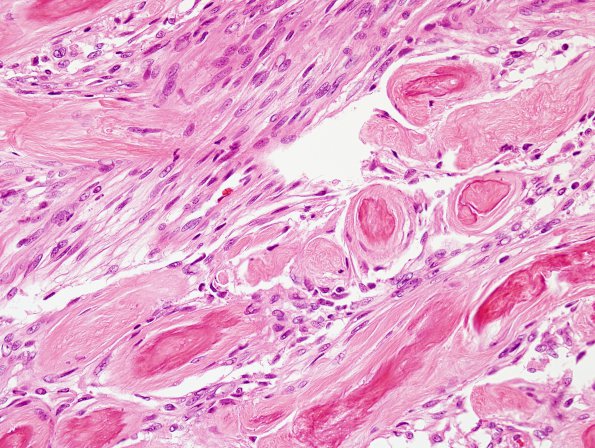 6B4 Meningioma, unusual psammoma bodies (Case 6) H&E 2.jpg