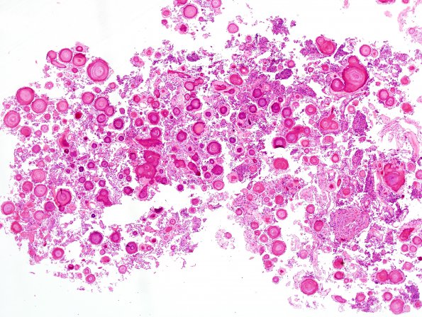 8B1 Meningioma, psammomatous (Case 8) H&E 4