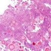 8B2 Meningioma, psammomatous (Case 8) H&E 5