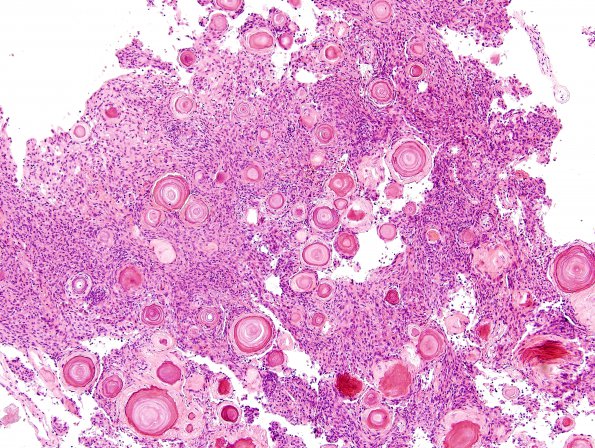 8B2 Meningioma, psammomatous (Case 8) H&E 5