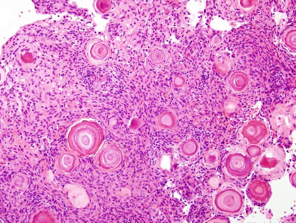 8B3 Meningioma, psammomatous (Case 8) H&E 3