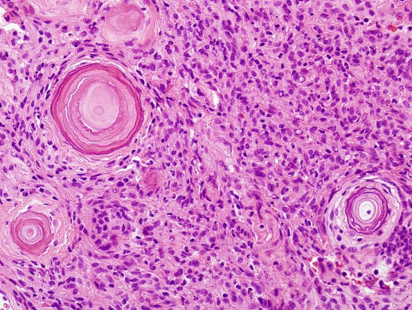 8B4 Meningioma, psammomatous (Case 8) H&E 1