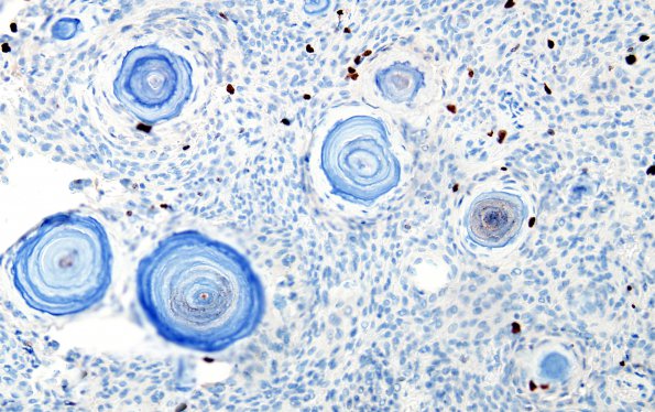 8C Meningioma, psammomatous (Case 8) MIB 2