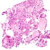 9A1 Meningioma, psammomatous (Case 9) H&E 1