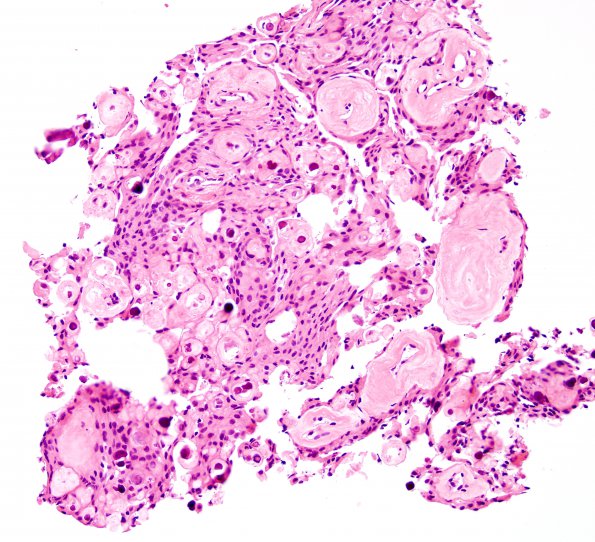 9A1 Meningioma, psammomatous (Case 9) H&E 1