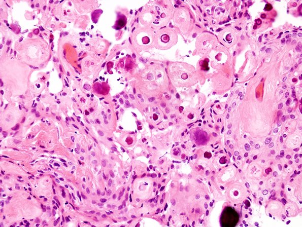 9A3 Meningioma, psammomatous (Case 9) H&E 4