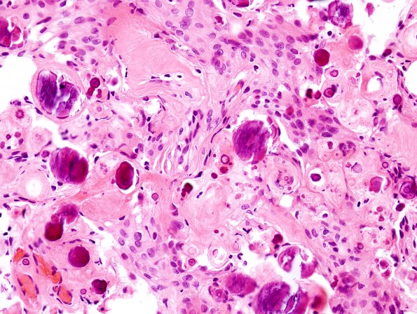 9A4 Meningioma, psammomatous (Case 9) H&E 3