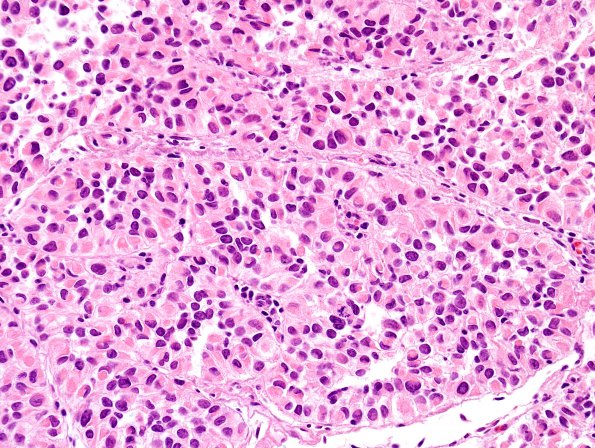 10A2 Meningioma, rhabdoid (Case 10) H&E 2.jpg