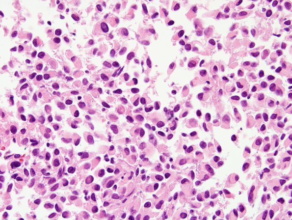 10A4 Meningioma, rhabdoid (Case 10) H&E 5.jpg