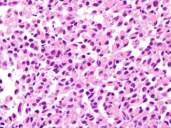 10A5 Meningioma, rhabdoid (Case 10) H&E 6.jpg