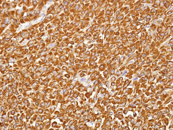 10C1 Meningioma, rhabdoid (Case 10) VIM 1.jpg