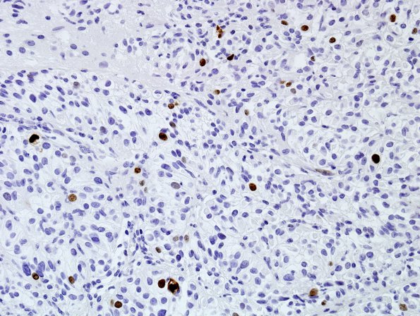 10D Meningioma, rhabdoid (Case 10) Ki67 1.jpg