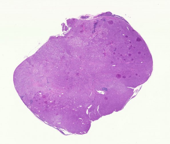 11A1 Meningioma, rhabdoid, Lymph node (Case 11) H&E WM