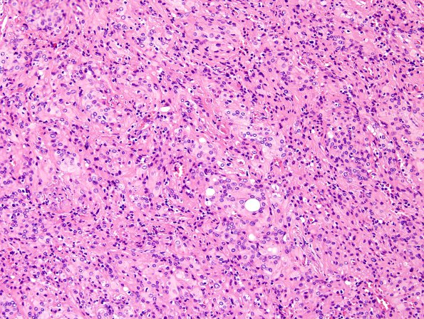 11A2 Meningioma, rhabdoid (Case 11) H&E 2.jpg