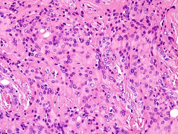 11A3 Meningioma, rhabdoid (Case 11) H&E 9.jpg