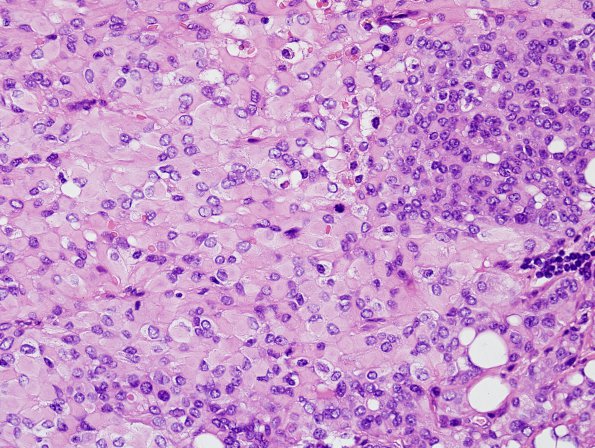 11A4 Meningioma, rhabdoid, Lymph node (Case 11) H&E 7.jpg