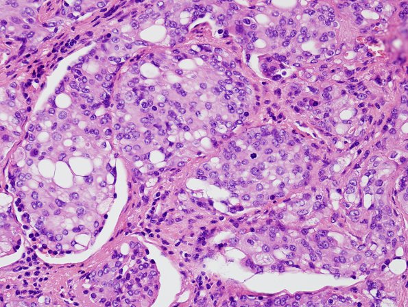 11A5 Meningioma, rhabdoid, Lymph node (Case 11) H&E 8.jpg